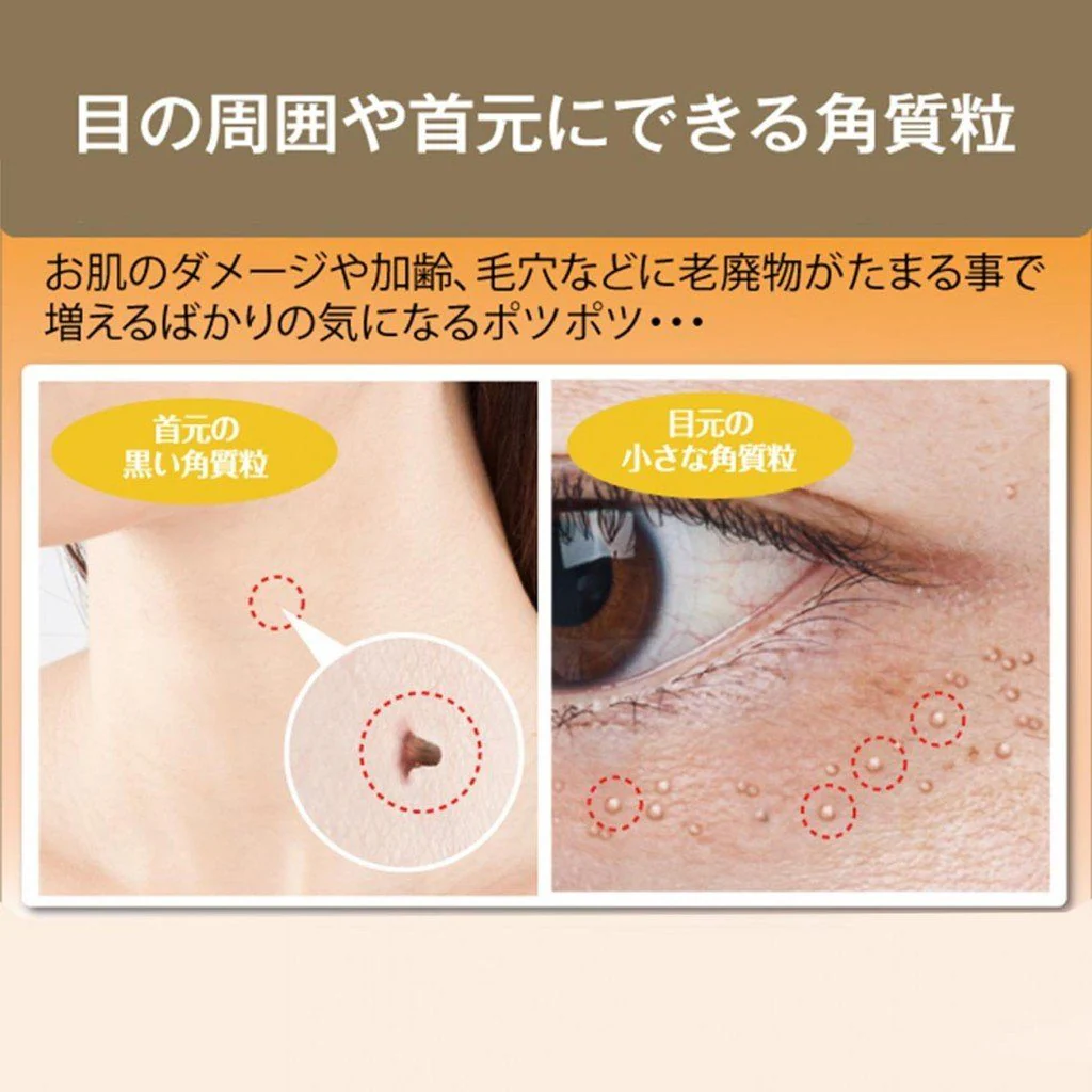 Tsubu Night Pack Wart Remover Cream 30g - Image 4